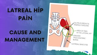 greater trochanteric pain syndrome gluteal tendinopathy lateral hip pain GTPS [upl. by Nixie]