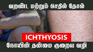 ICHTHYOSIS நோயின் தன்மை குறைய வழி  JKT SKIN [upl. by Hedvige]