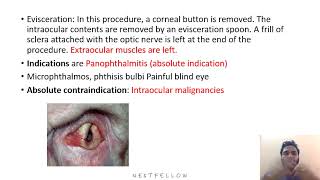 ophthalmology Destructive ocular surgeries concept for neetpg Inicet Fmge Next mbbs [upl. by Nikolia]