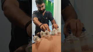 Cupping therapy for upper back pain bestphysiotherapy [upl. by Aital]