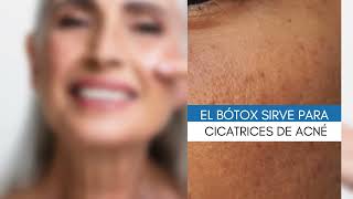 El botox sirve para cicatrices de acné Nop pero mira el video [upl. by Zanahs]