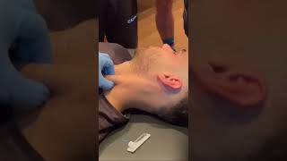 Dry Needling to the SCM for neck pain acupuncture scm dryneedling [upl. by Pierrette]