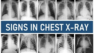 Signs in Chest Xray [upl. by Einnahpets361]