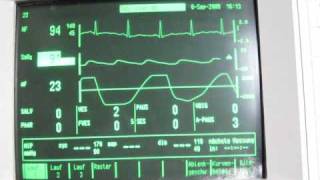 breath hold EKG with oxygen desaturation [upl. by Etat]