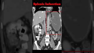 Splenic infarction  Cect Abdomen  Abdomen CT shorts radiology splenicinfrection [upl. by Yahsram]