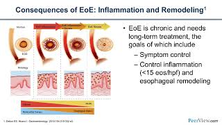 The Latest on New Options for Eosinophilic Esophagitis Considering Targeted Biologic Therapy [upl. by Oravla399]