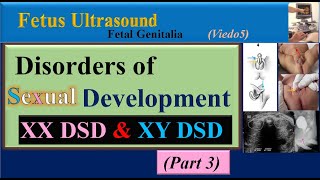 Fetus Ultrasound Disorders of Sexual Development Part3 [upl. by Furiya]