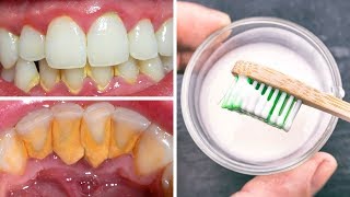 Remove Tartar From Teeth With A Recipe Your Dentist Will Never Tell You [upl. by Otho914]