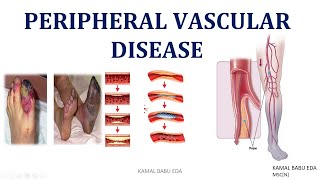 PERIPHERAL VASCULAR DISEASESPART A Thromboangitis obliterans Raynauds diseasesAneurysm [upl. by Linoel]