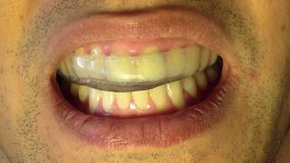 Bruxism Splint  Part 6  Insertion and Occlusion [upl. by Faludi16]