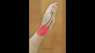 De Quervains Tenosynovitis Quick Fix in 5 Steps [upl. by Nelyahs]