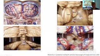 Neurosurgical Case Report FCN Tyumen Russia [upl. by Nelleoj]