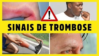 TROMBOSE 10 SINAIS E SINTOMAS e 12 CAUSAS da trombose esteja alerta e protejase Dr Alain Dutra [upl. by Ary]