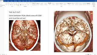 How to make COW reconstructions of CTA head exams using TeraRecon video 1 of 3 [upl. by Agler]