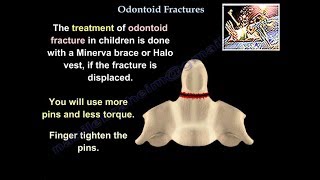 Odontoid Fractures  Everything You Need To Know  Dr Nabil Ebraheim [upl. by Strohl]