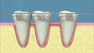 bodily tooth movement x264 [upl. by Arukas]