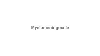 How to Pronounce quotMyelomeningocelequot [upl. by Gilder25]