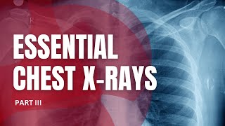 Essential Chest Xrays for Students Part III [upl. by Mauldon870]