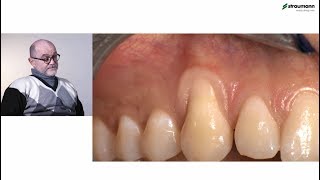 Prof Giovanni Zucchelli Treatment of class I gingival recession [upl. by Dagney498]