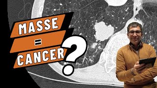 Toute masse pulmonaire est un cancer jusquà preuve du contraire  Cas clinique didactique en TDM [upl. by Jeniece]