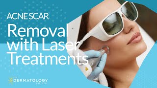 Acne Scar Removal with Laser Treatments [upl. by Rockel490]