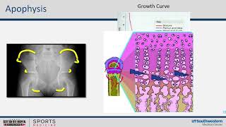 Hip and Pelvis Apophysitis [upl. by Aneris]