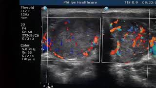 Thyrotoxicosis Sonography [upl. by Laehplar758]