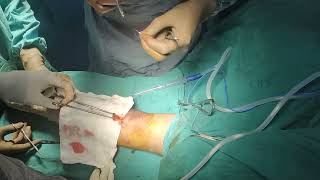 Biceps tendon avulsion repair [upl. by Anairt]