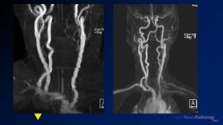 Neuroradiology board review 2 case 5 [upl. by Akaenahs]