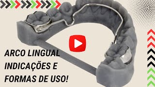 O arco Lingual Quais as suas indicações e formas de uso  Aula 152 [upl. by Yecnay]