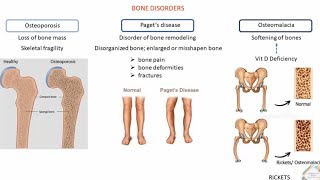 BONE DISORDERS AND TREATMENT [upl. by Ahsiym]