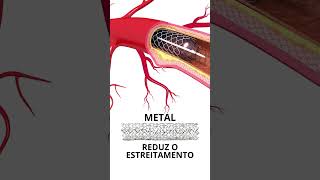 Angioplastia com STENT [upl. by Eralcyram]