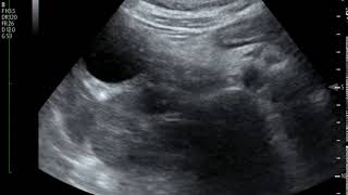 Acute Cholecystitis Ultrasound JETem 2018 [upl. by Tamra322]