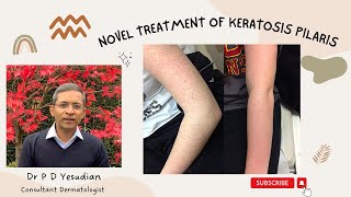 A novel treatment for Keratosis pilaris [upl. by Jecoa]