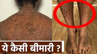 Ichthyosis vulgaris Disease क्या है Symptoms Reason Treatment । Boldsky Health [upl. by Beore375]