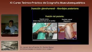 2019 Infiltraciones glenohumerales ecoguiadas en la capsulitis retráctil de hombro [upl. by Ronald]