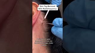 Skin Tag Removal With Radiofrequency  Quick amp Safe Treatment DRMEDISPA [upl. by Duval]