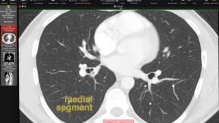 USMLE Respiratory 1 Lung Anatomy and Embryology [upl. by Killian]