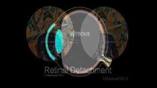 Retinal Detachment [upl. by Ney]