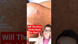 Standout BLACKHEAD REMOVAL  How To Shrink Pores shorts [upl. by Aivyls839]