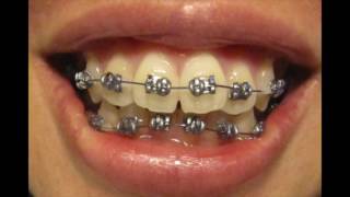 Quick Braces Progression [upl. by Jena583]