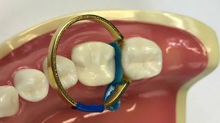 Building up deep proximal box using OVC wedge and retainer ring  Dr Simon McDonald [upl. by Bonita957]