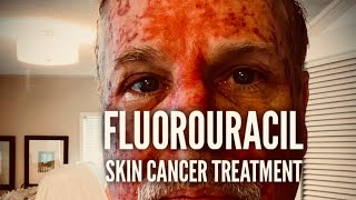 Fluorouracil Skin Treatment  Before During and After [upl. by Atiloj394]