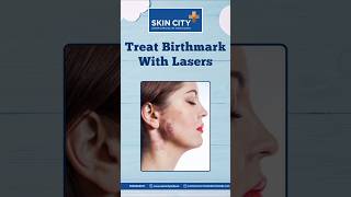 Treat Your Birthmarks With Lasers viralshorts newshorts youtubeshorts [upl. by Briscoe]