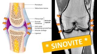 SINOVITE NO JOELHO [upl. by Pine410]