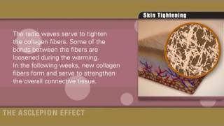 Skin tightening with radiofrequency of Effect systems by Asclepion [upl. by Isolt704]