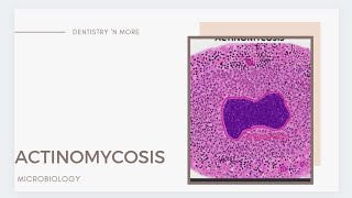 ACTINOMYCOSIS [upl. by Greenebaum]