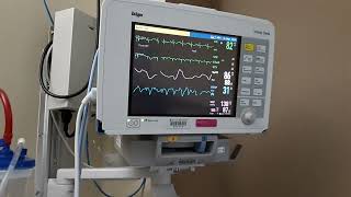 How Read PATIENT MONITOR in Hospital Resp SpO2 Pls HR Arr NBP Alarm Meaning Use Monitoring System [upl. by Lseil]