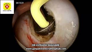 BIPOLAR TUVP amp TURP PROSTATE RESECTION FOR PROSTATIC HYPERTROPHY DR AVINASSH SHAHARE SHALYA TUROSEAL [upl. by Airbmac]