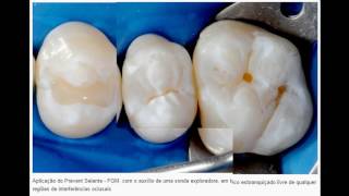 ODONTOPEDIATRIA Protocolo clínico para aplicação do selante de fóssulas e fissuras [upl. by Brandt]